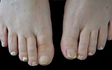 Ako sa zbaviť húb na prstoch