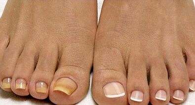 Metódy liečby húb flotily