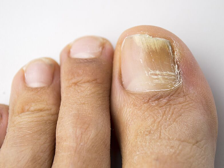 Počiatočná fáza huby