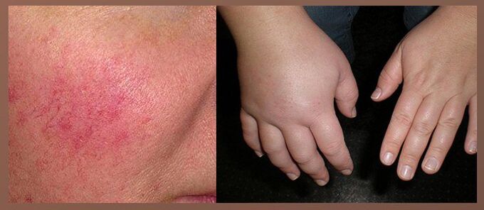 Vedľajšie účinky kvapiek